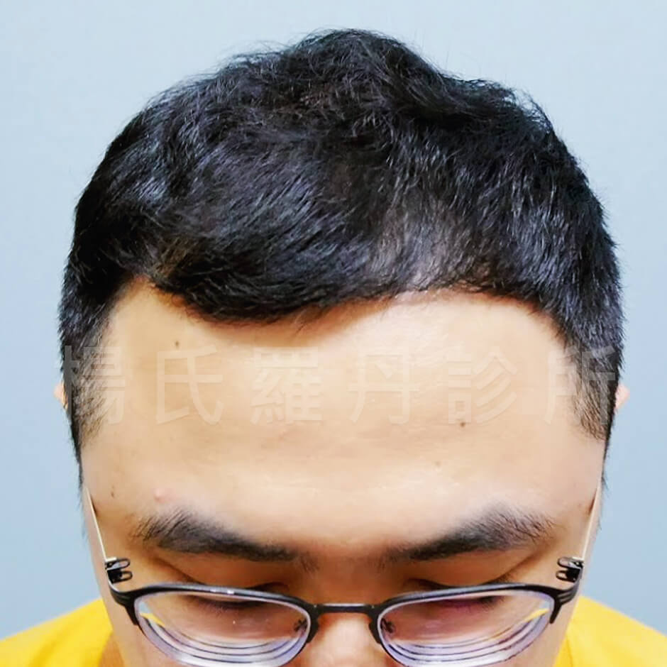 複合式生髮  生髮  植髮  六合一三階段雄性禿治療 禿頭